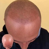 Master Class MedEstetique Trico Scalp